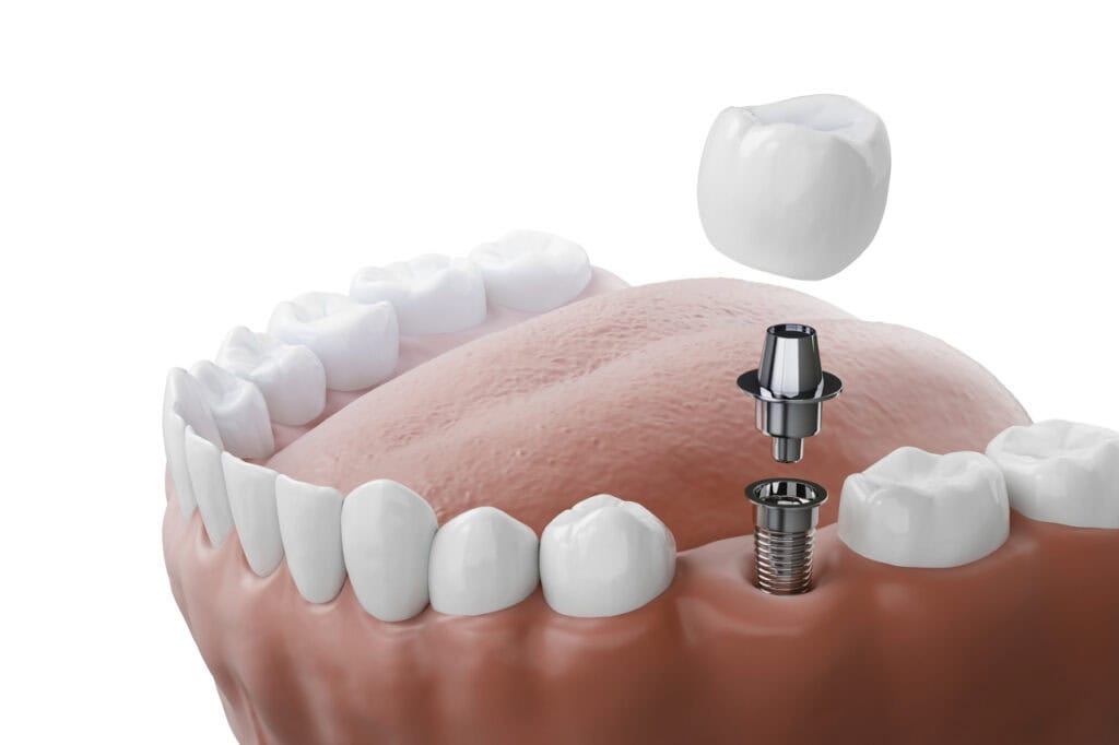 Dental Implants in Farmington