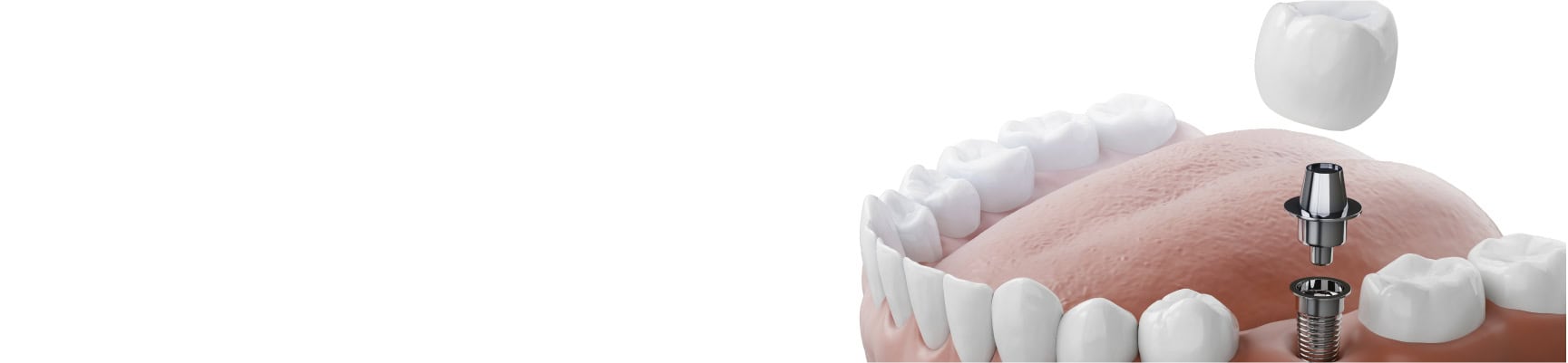 Dental Implants in Farmington